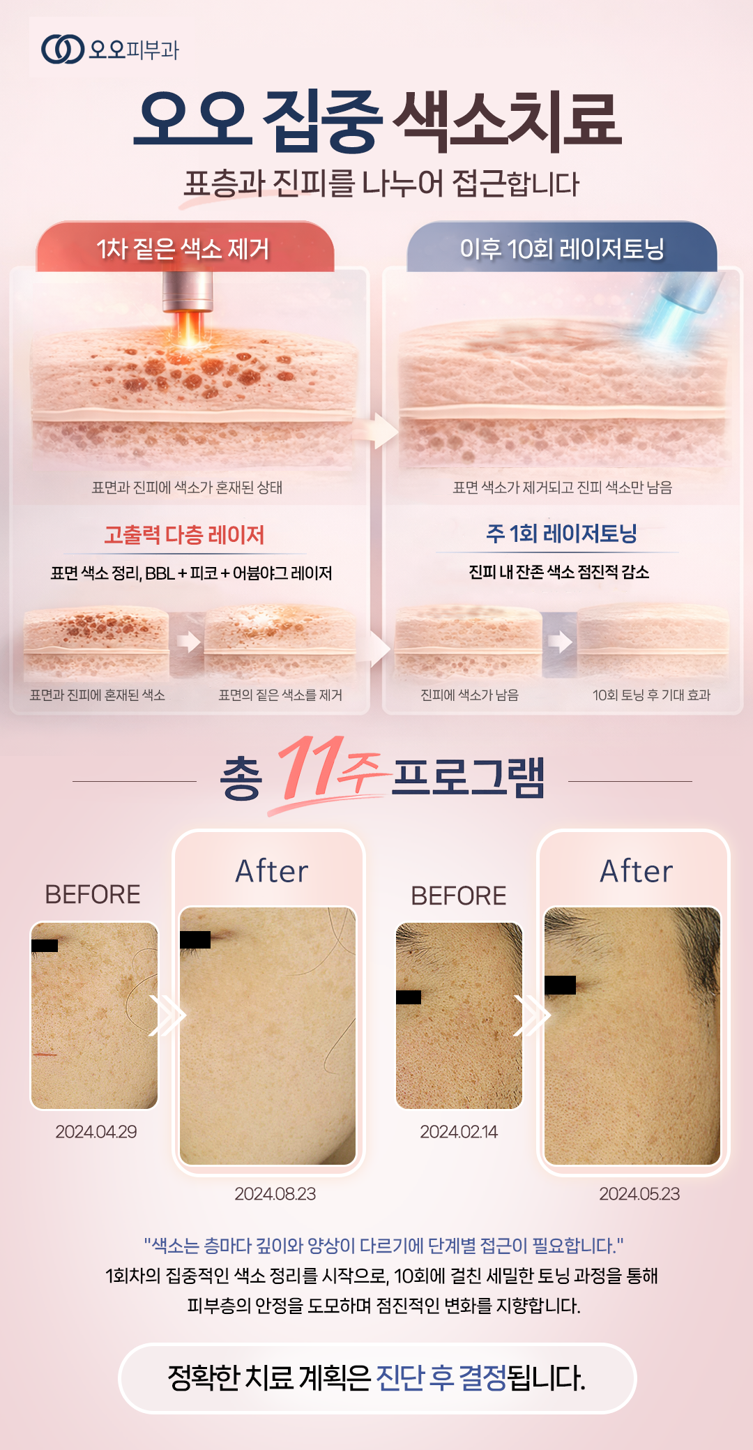 현풍오오피부과기미치료