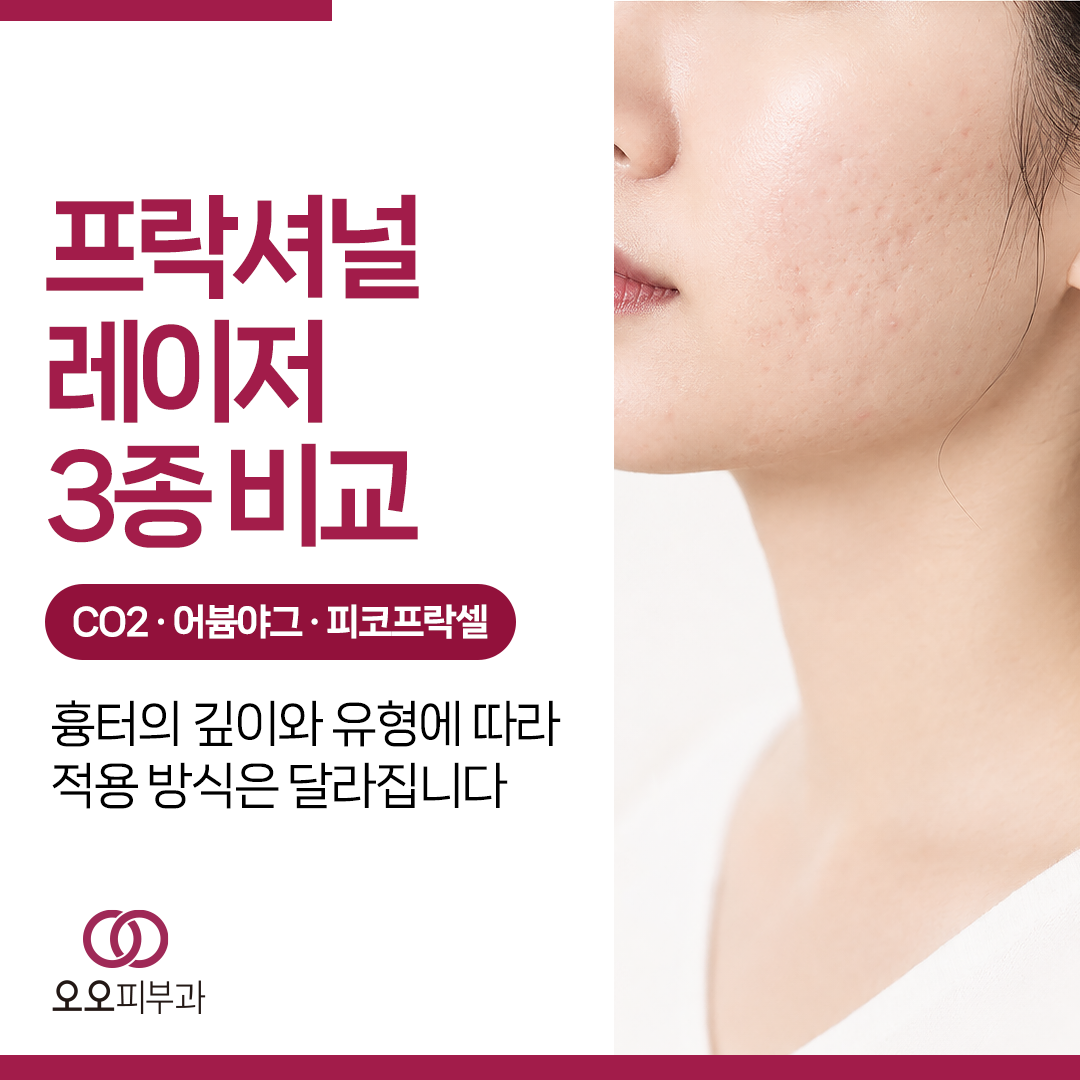 패인 얼굴흉터에 사용하는 프락셔널 레이저 차이 안내