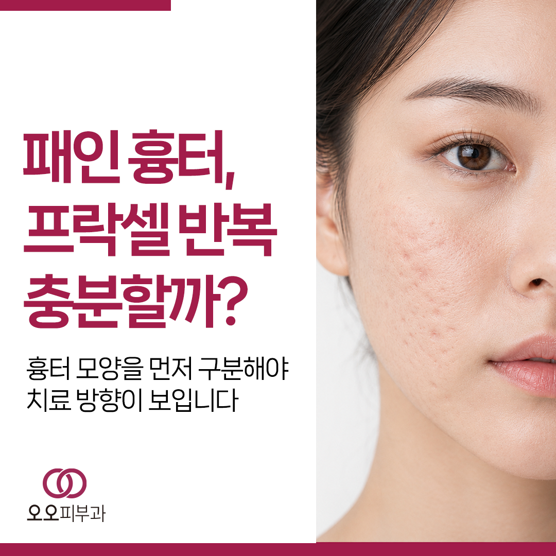 프락셀을 반복해도 패인 여드름흉터가 남는 이유