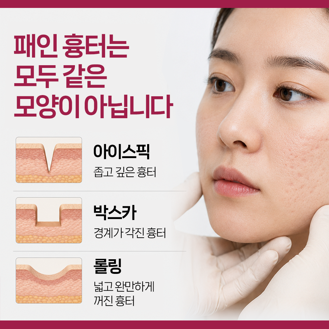대구 여드름흉터 치료 전 아이스픽 박스카 롤링 흉터를 구분하는 방법