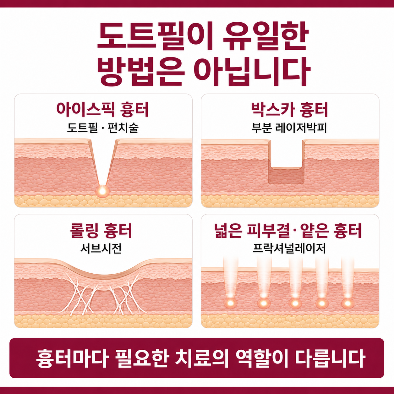 도트필 외 아이스픽 박스카 롤링 흉터별 치료 선택