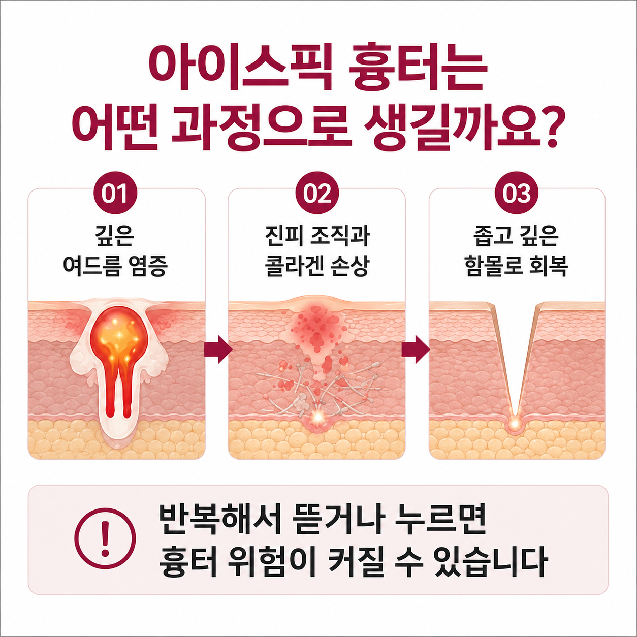 깊은 여드름 염증이 아이스픽 흉터로 남는 과정
