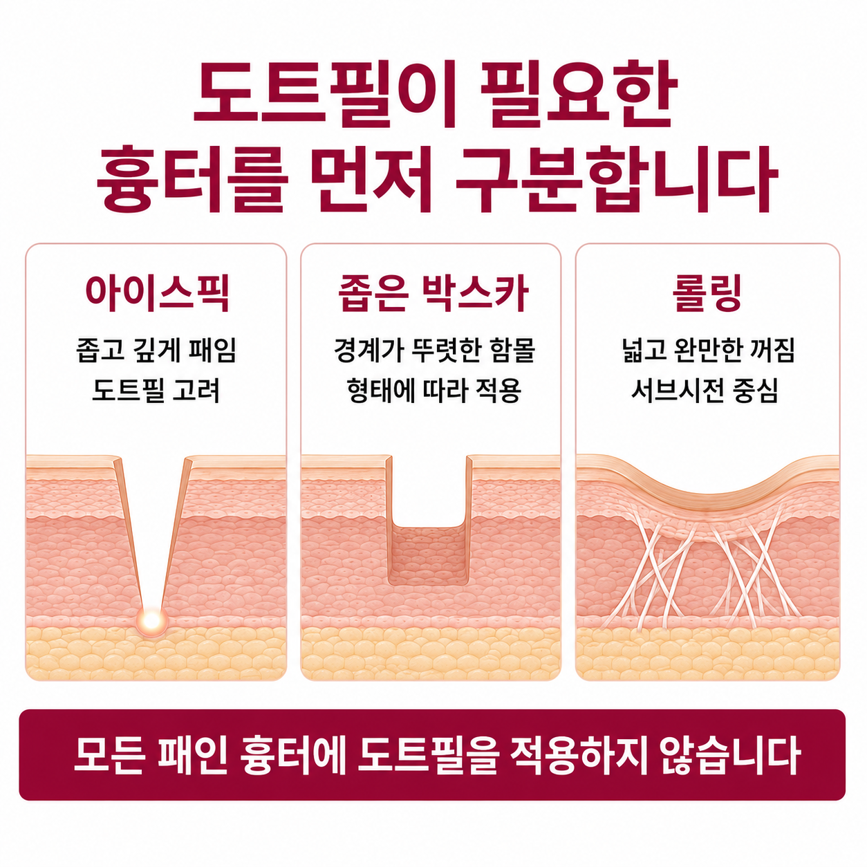 아이스픽 박스카 롤링 흉터별 도트필 적용 기준