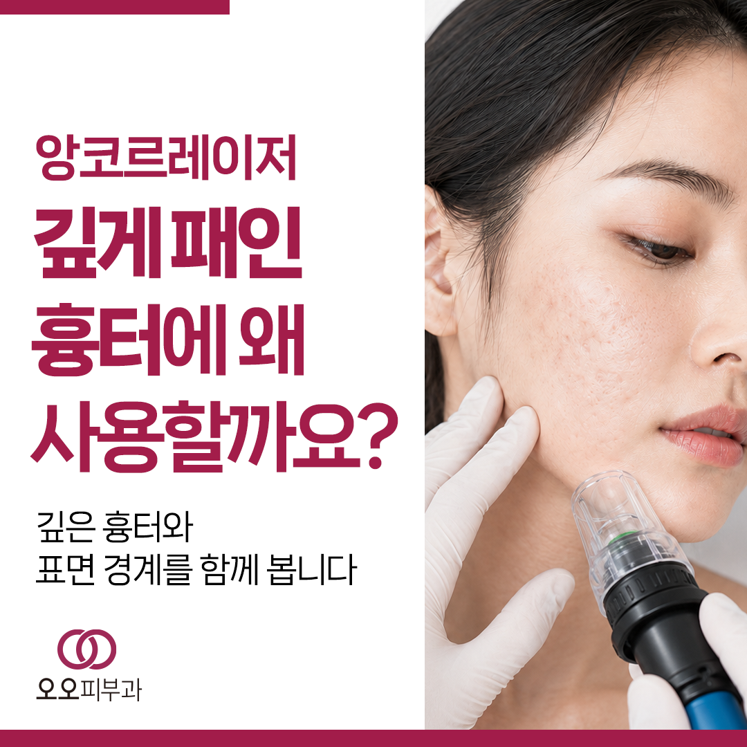 깊게 패인 여드름흉터에 앙코르 레이저를 사용하는 이유