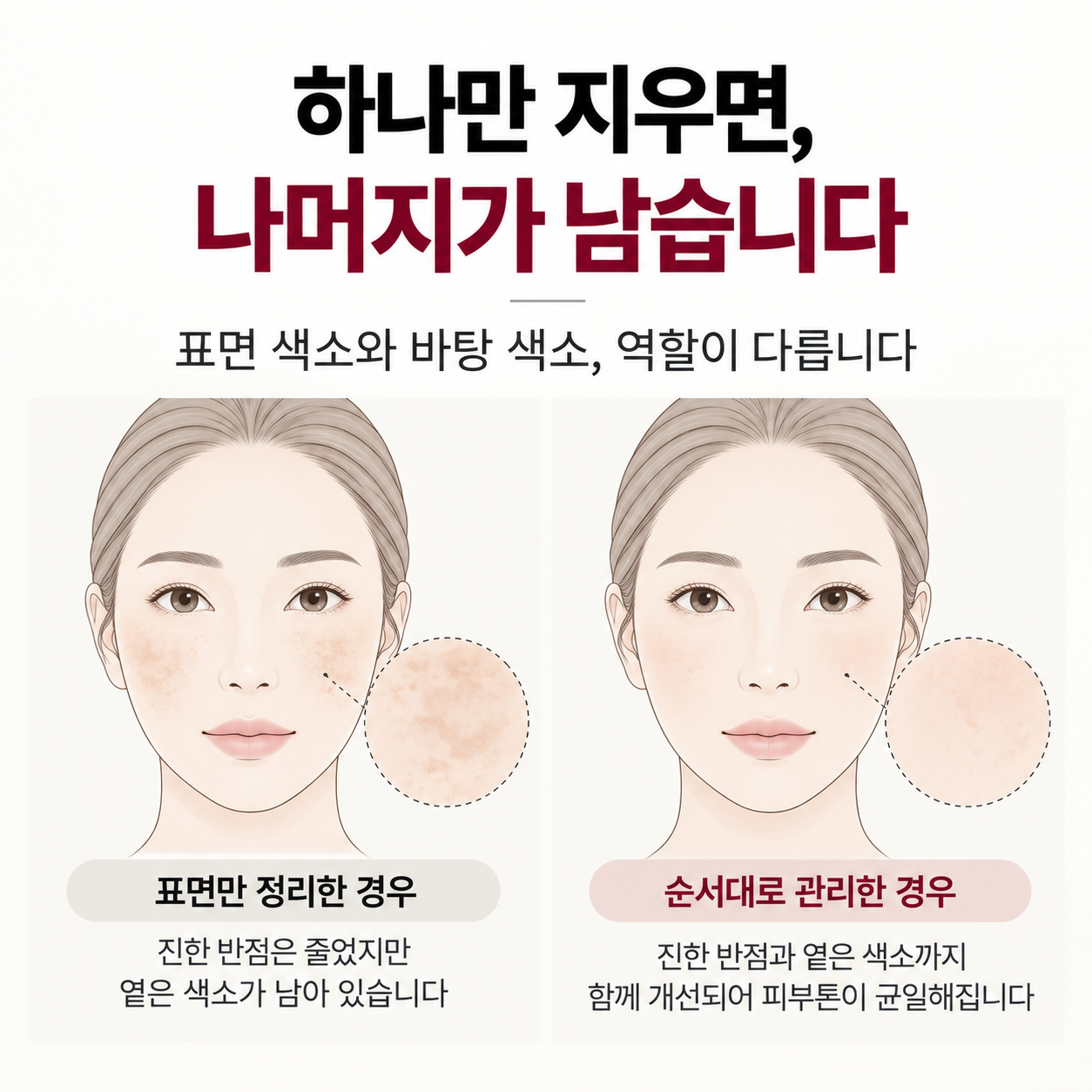 기미와 잡티가 함께 있는 혼합 색소를 나누어 치료하는 설명 이미지
