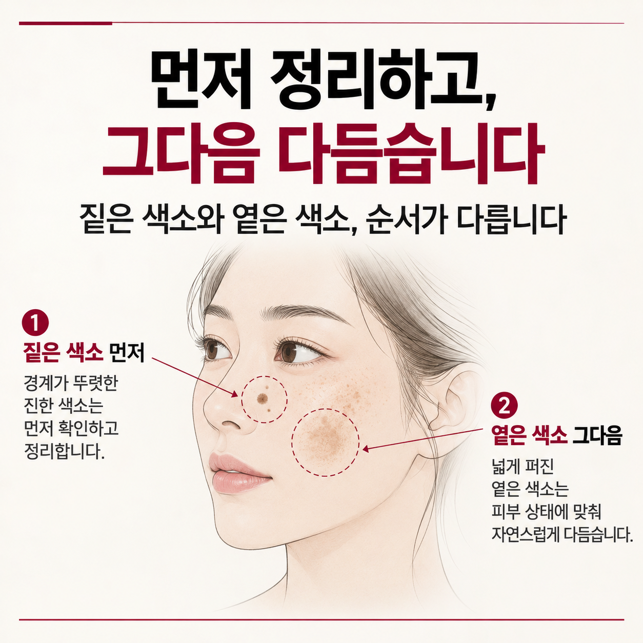 대구기미잡티피부과 짙은 색소를 먼저 정리하고 기미는 이어서 관리하는 치료 순서