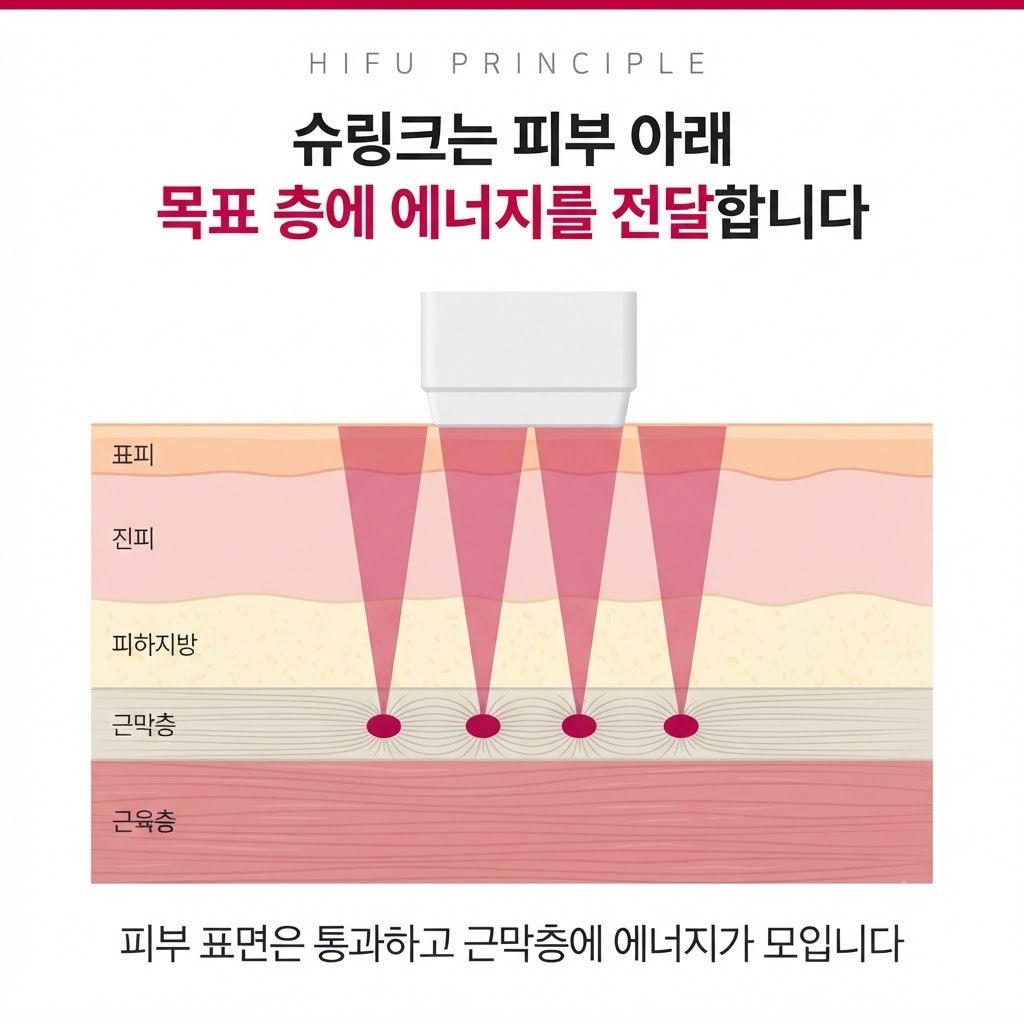 슈링크 HIFU가 피부 아래 목표 층에 에너지를 전달하는 원리