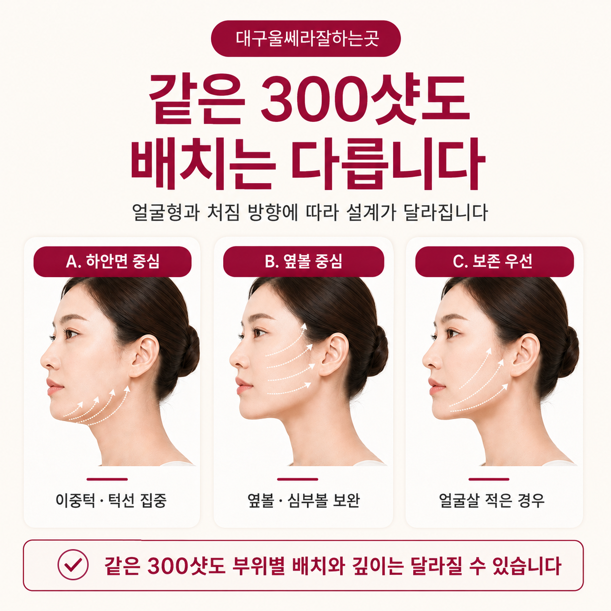 울쎄라 300샷의 얼굴형별 깊이와 부위 배치 차이
