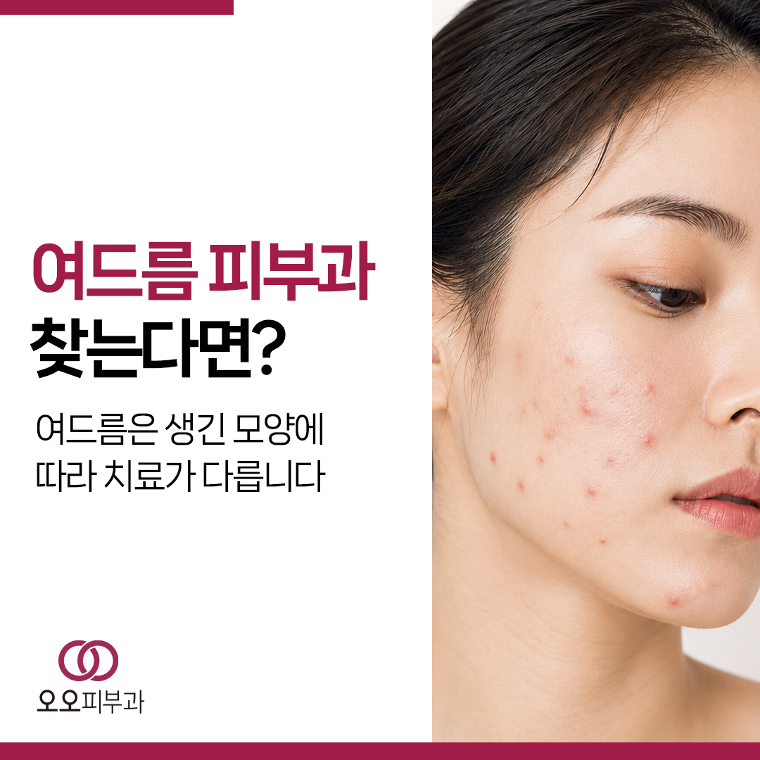 여드름 모양에 따라 달라지는 치료 기준 안내