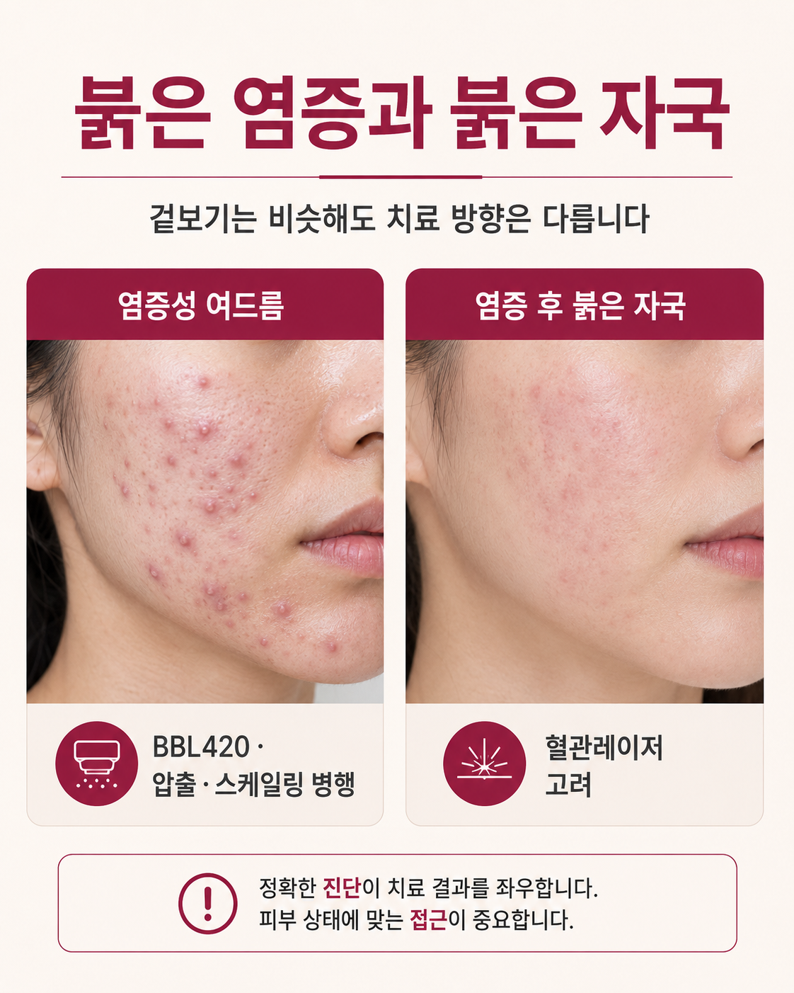 달서구여드름피부과 피부 상태별 여드름 치료 기준