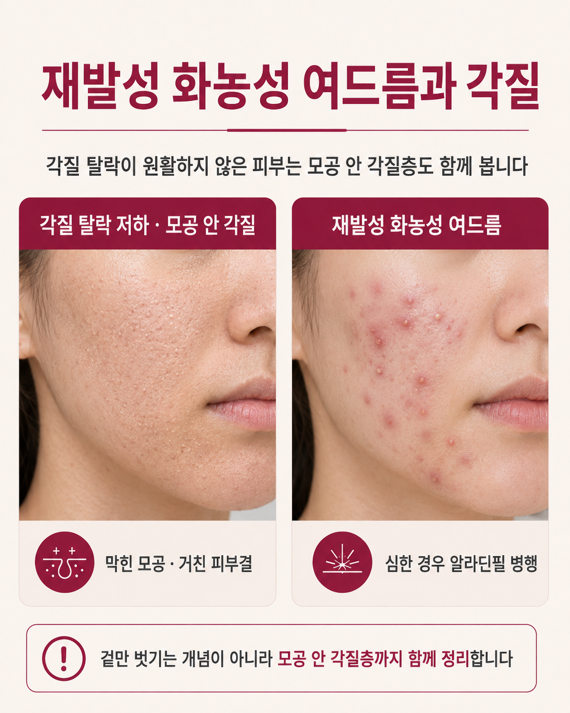달서구여드름피부과 재발성 화농성 여드름과 모공 각질 치료 방향