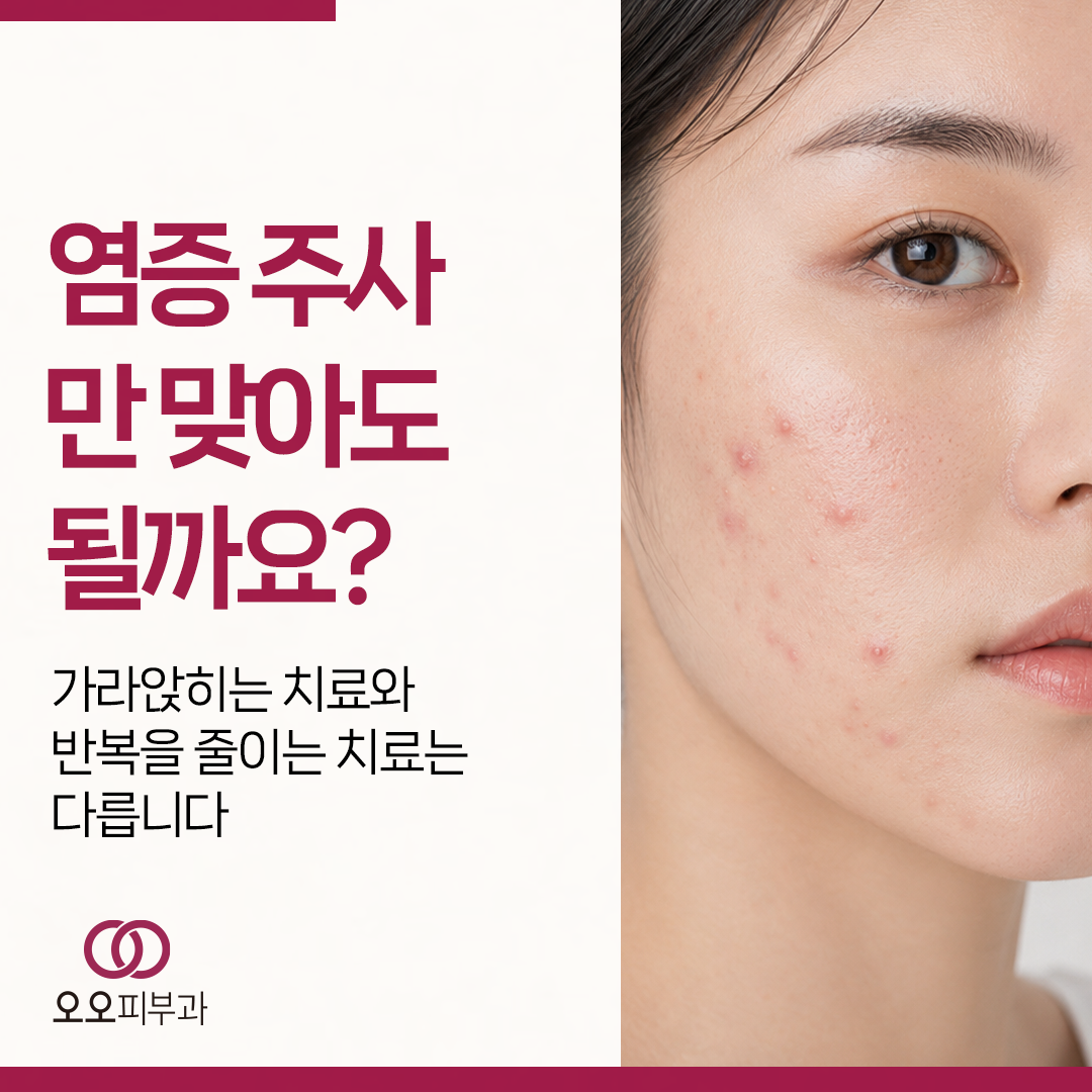 반복되는 염증성 여드름과 염증주사 치료 기준