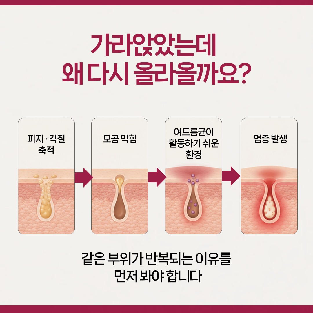 현풍피부과 여드름에서 각질과 피지의 모공 막힘, 여드름균 활성과 염증 반응 과정을 설명하는 이미지