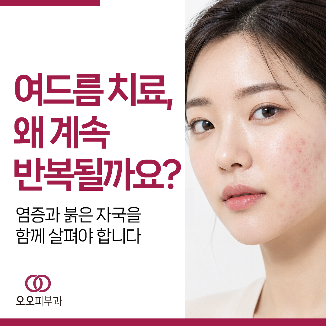 반복되는 붉은 여드름의 치료 기준