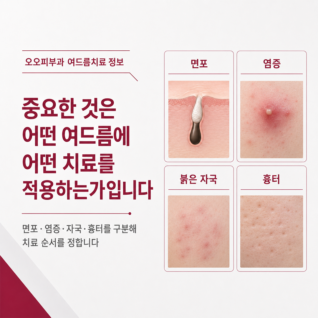 상인동 피부과 여드름 진료에서 면포 염증 붉은 자국 흉터를 구분하는 치료 과정