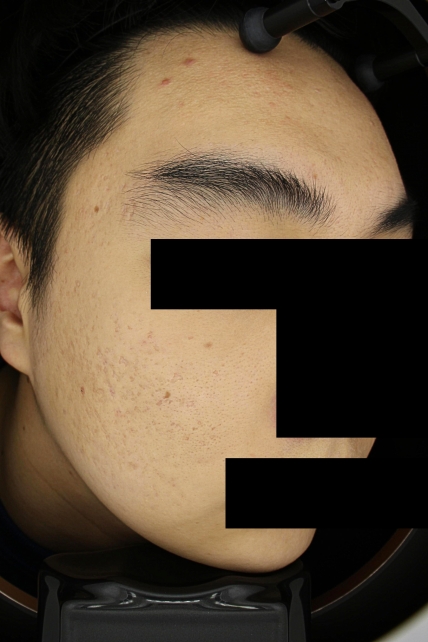 여드름 치료 후 사진 3