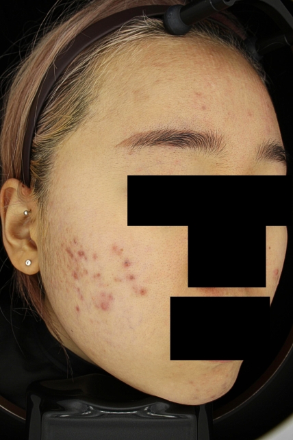 여드름 치료 전 사진 3