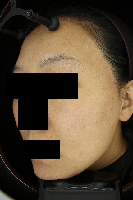 여드름 치료 후 사진 2