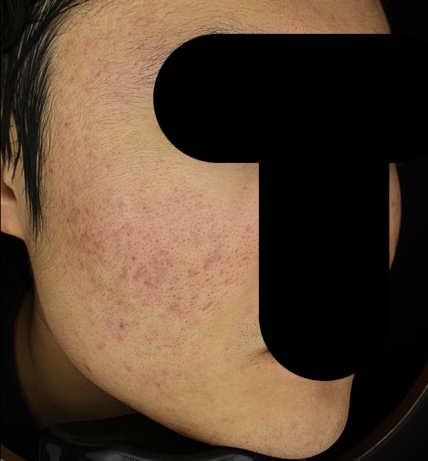 여드름 치료 후 사진 3