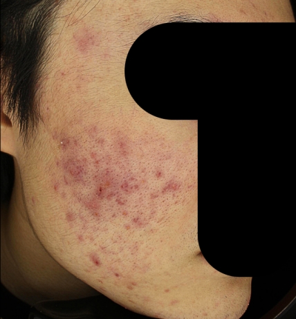 여드름 치료 전 사진 3