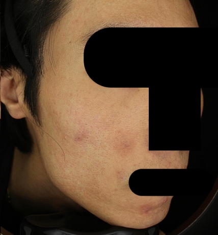여드름 치료 후 사진 2