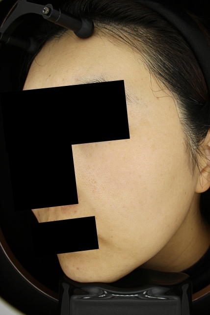 여드름 치료 후 사진 2