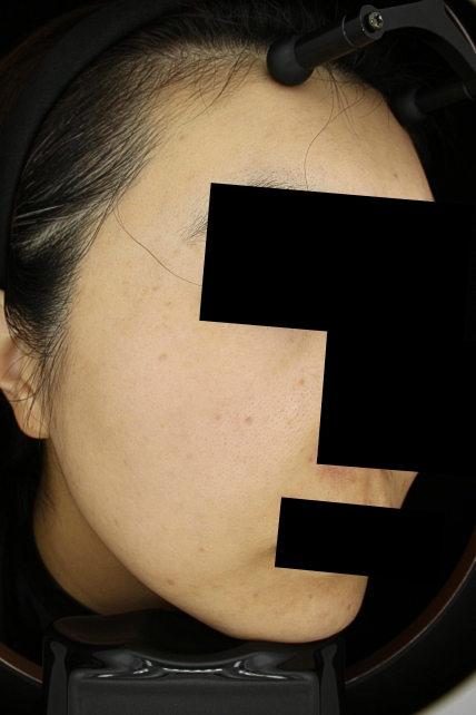 여드름 치료 후 사진 3
