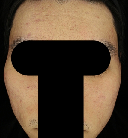 여드름 치료 후 대표 사진 16