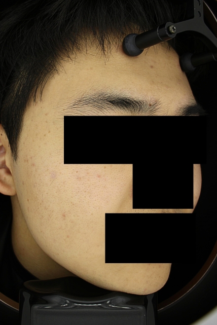 여드름 치료 후 사진 3