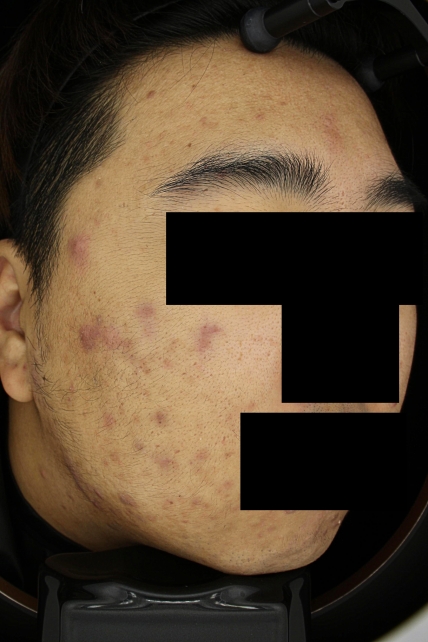 여드름 치료 전 사진 3