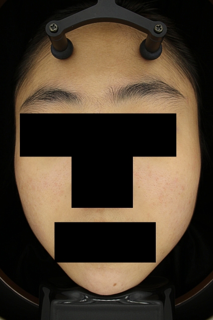 여드름 치료 후 대표 사진 22