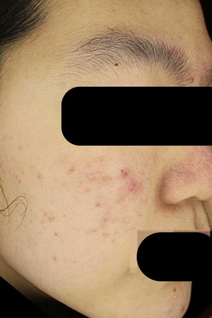 여드름 치료 후 대표 사진 27