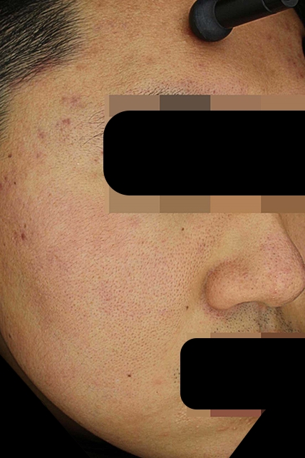여드름 치료 후 대표 사진 28