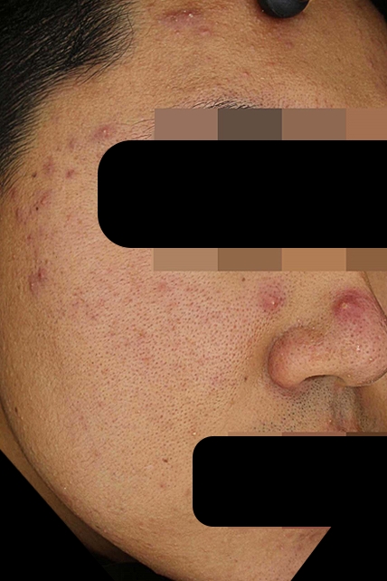 여드름 치료 전 대표 사진 28