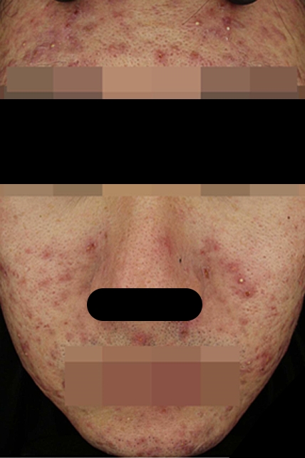 여드름 치료 전 대표 사진 29