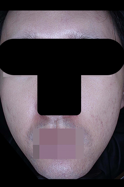 여드름 치료 후 대표 사진 30