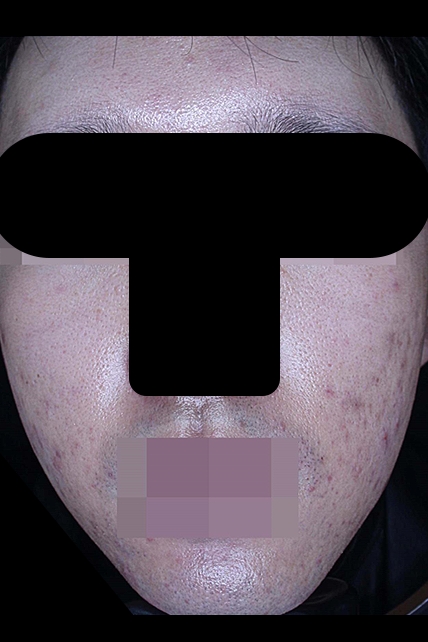 여드름 치료 전 대표 사진 30