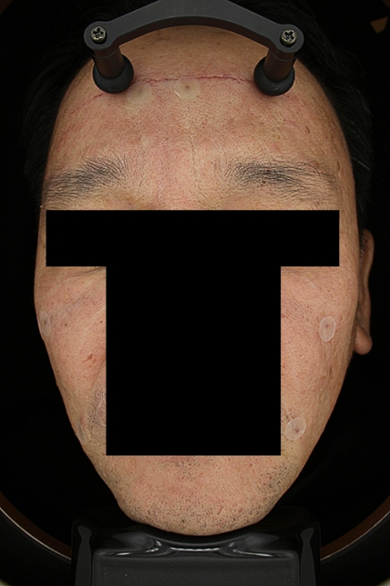 목주름 치료 치료 후 대표 사진