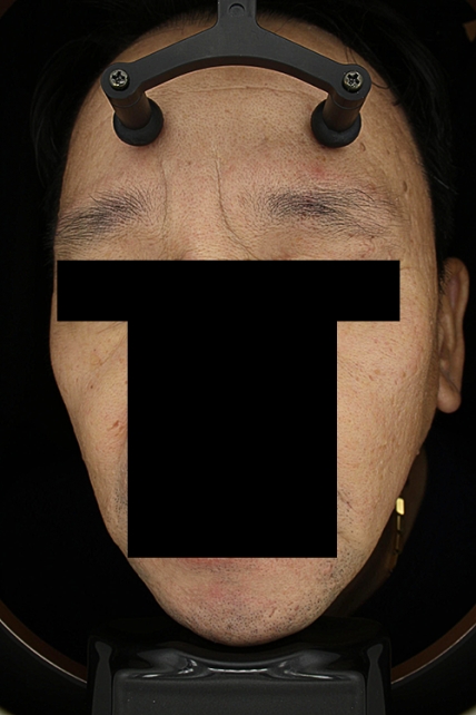 목주름 치료 치료 전 대표 사진