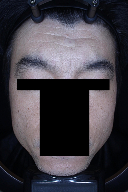 쁘띠 치료 후 대표 사진 06