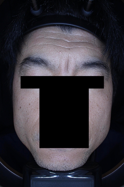 쁘띠 치료 전 대표 사진 06