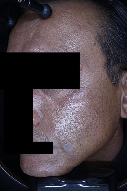 쁘띠 치료 후 대표 사진 12