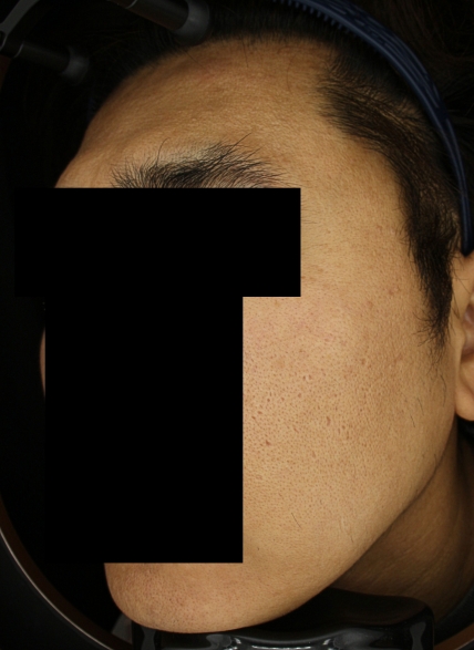 쁘띠 치료 후 대표 사진 16