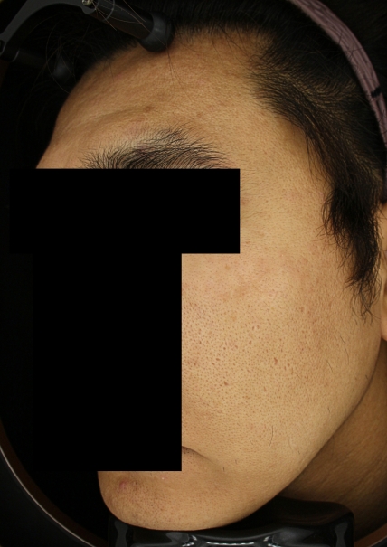 쁘띠 치료 전 대표 사진 16