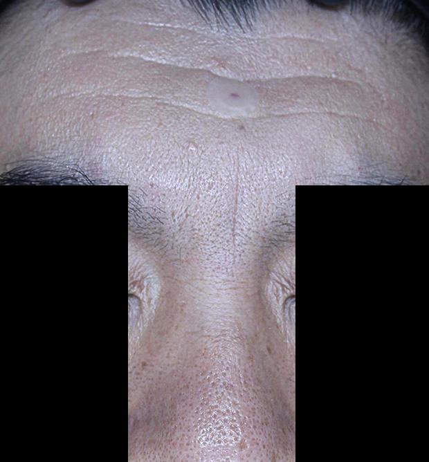 쁘띠 치료 후 대표 사진 20