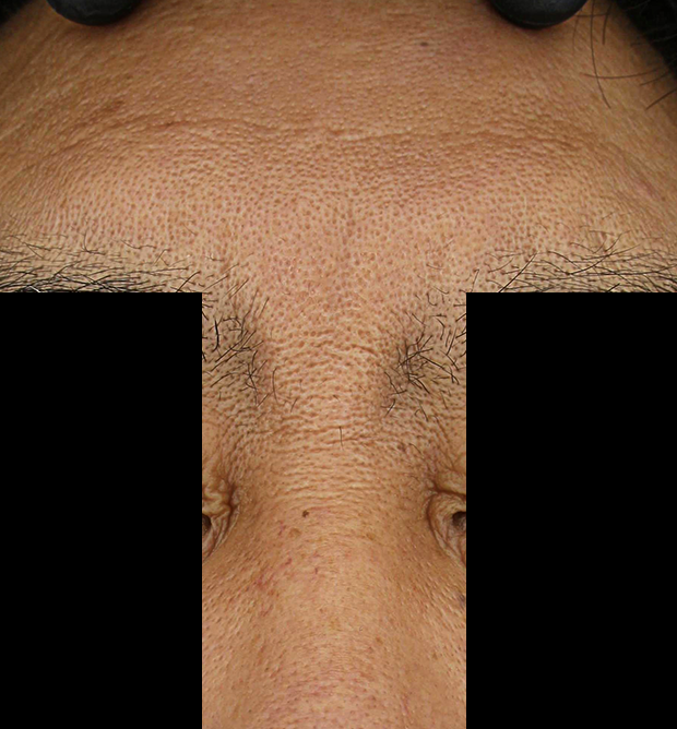 쁘띠 치료 후 대표 사진 22