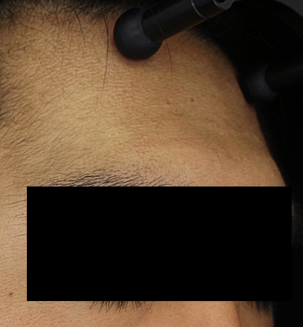 쁘띠 치료 후 대표 사진 23