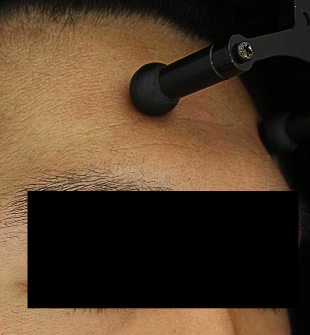 쁘띠 치료 전 대표 사진 23