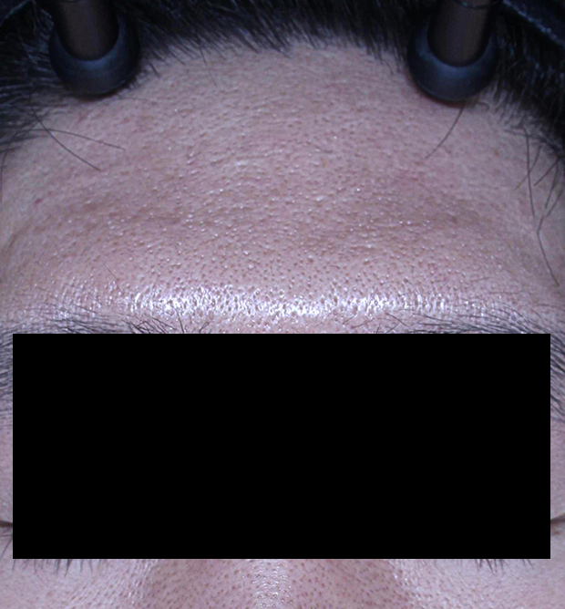 쁘띠 치료 후 대표 사진 24