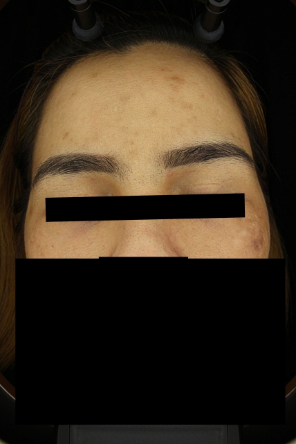 기미·색소 치료 후 대표 사진 01